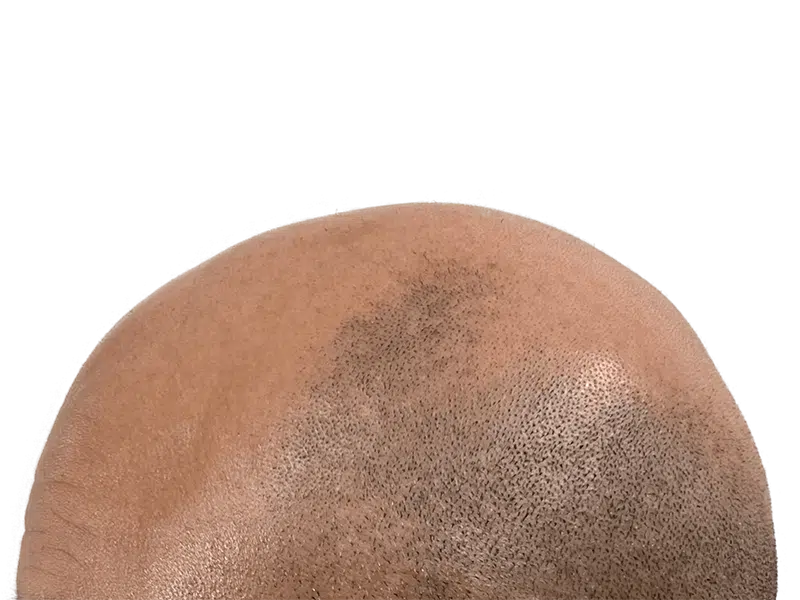 Hair loss in Black/Hispanic male. Possible hair transplant candidate. Before/after comparison needed for assessment.