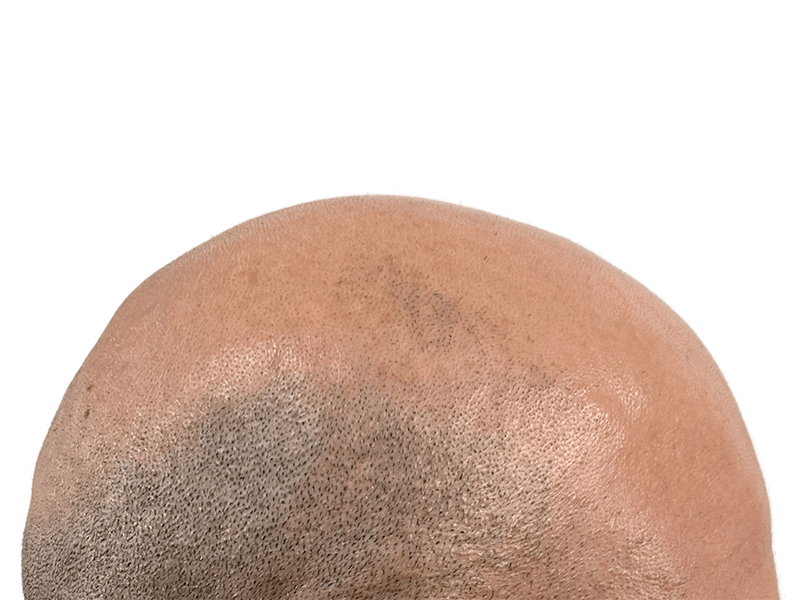 Hair transplant result: Close-up of restored hair growth on a balding scalp. Effective hair restoration procedure.