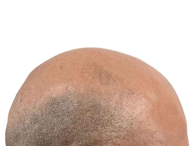 Hair transplant result: Close-up of restored hair growth on a balding scalp. Effective hair restoration procedure.