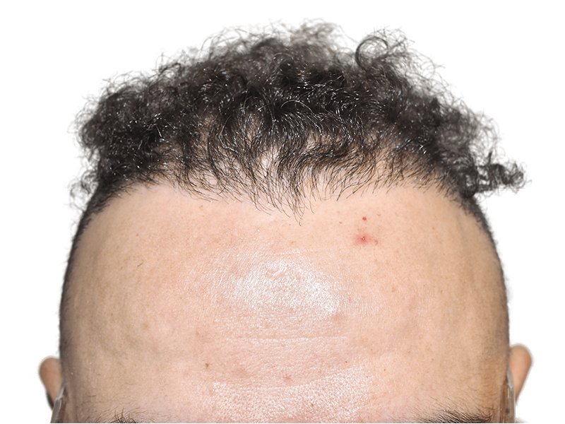 Hair transplant before & after: Hispanic man's hairline restored. Dark, curly hair growth. Hair restoration results.