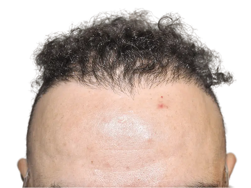 Hair transplant before & after: Hispanic man's hairline restored. Dark, curly hair growth. Hair restoration results.