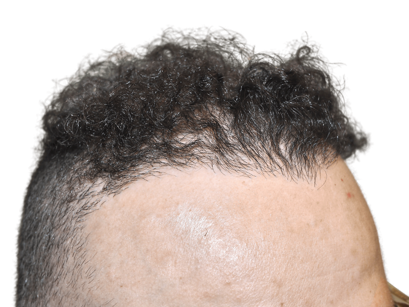 Hair transplant result: Close-up of restored hairline. Before & after hair restoration procedure.