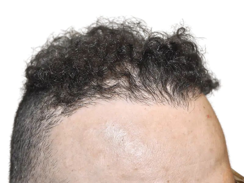 Hair transplant result: Close-up of restored hairline. Before & after hair restoration procedure.