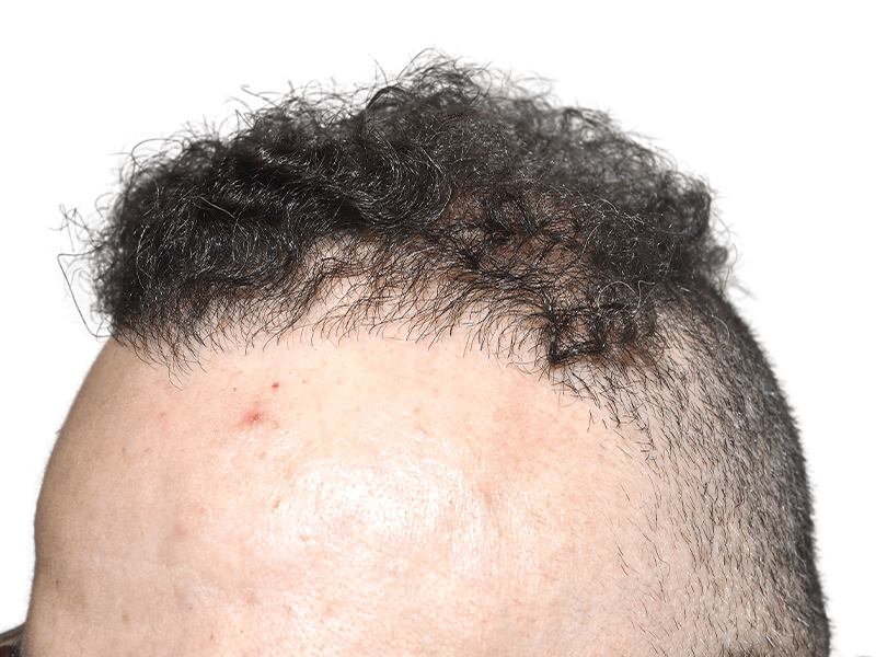 Receding hairline before hair transplant. Dark, curly hair shows sparse growth. Hair restoration results in progress.