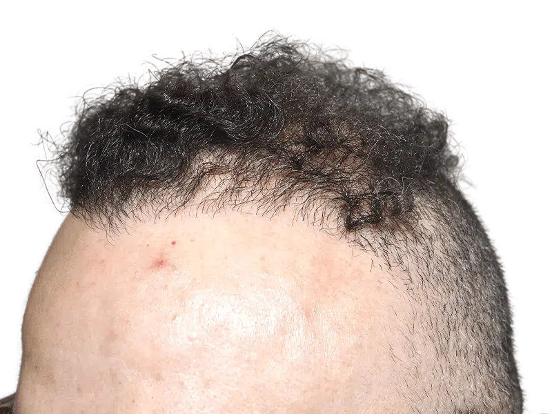 Receding hairline before hair transplant. Dark, curly hair shows sparse growth. Hair restoration results in progress.