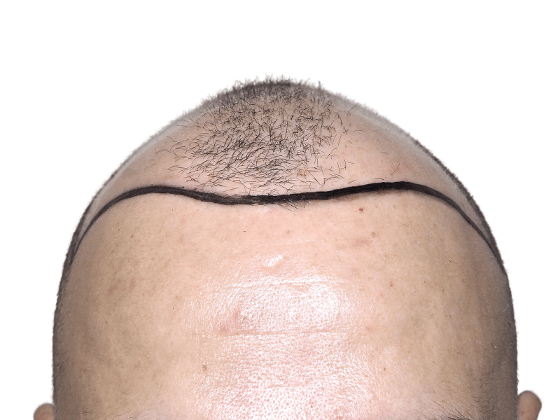 Before hair transplant: Marked hairline shows hair loss. Forehead view for hair restoration planning.