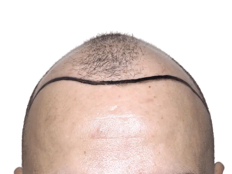 Before hair transplant: Marked hairline shows hair loss. Forehead view for hair restoration planning.