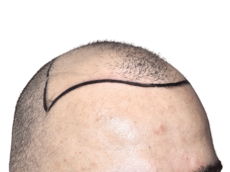 Hair transplant result: Close-up of restored hairline. Caucasian man's forehead after hair restoration procedure.