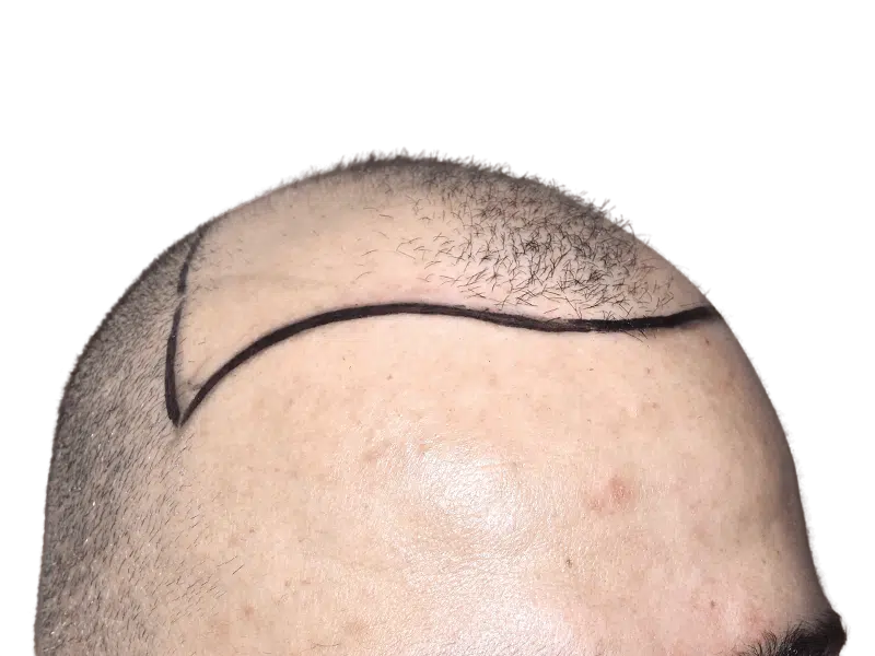 Hair transplant result: Close-up of restored hairline. Caucasian man's forehead after hair restoration procedure.