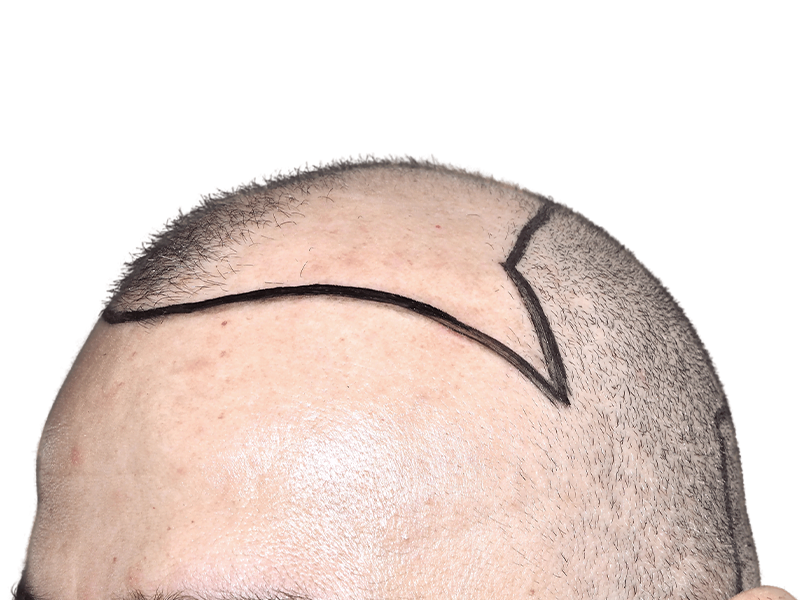 Hair transplant planning: Marked hairline on Caucasian man. Procedure outline for hair restoration. Before/after results coming soon.