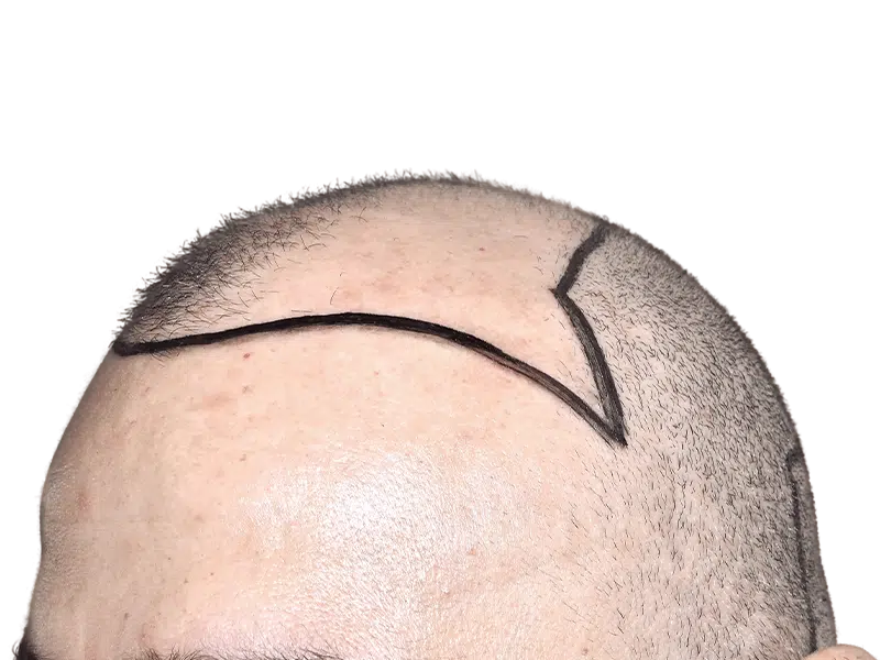 Hair transplant planning: Marked hairline on Caucasian man. Procedure outline for hair restoration. Before/after results coming soon.