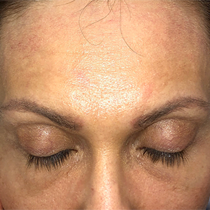 Thinning hairline on forehead. Potential hair restoration candidate. Before hair transplant consideration.