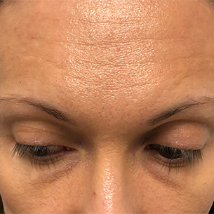 Woman's forehead showing fine lines. Could be a candidate for hair restoration. Before treatment example.