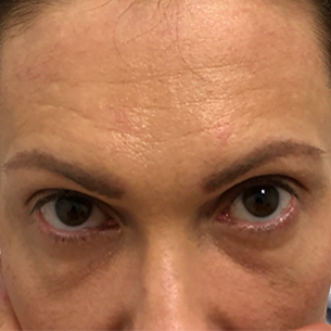 Woman's face showing forehead wrinkles. Could be a candidate for hair restoration to lower hairline and reduce wrinkles.