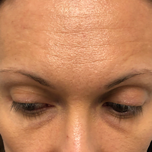 Woman's face showing forehead wrinkles. Not a hair transplant result. Example of aging before potential hair restoration.