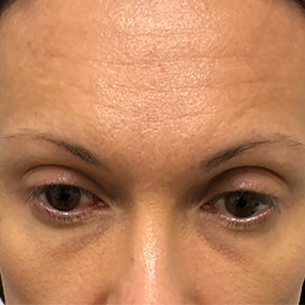 Forehead wrinkles. Could be a before photo for hair restoration or eyebrow transplant results. Light brown skin.