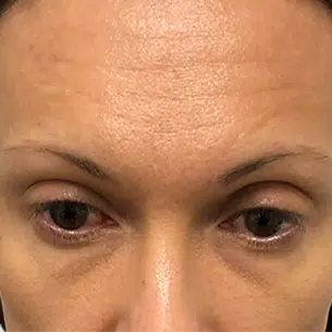 Forehead wrinkles. Could be a before photo for hair restoration or eyebrow transplant results. Light brown skin.
