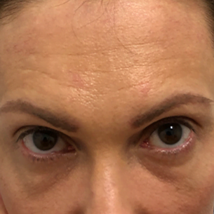 Woman's face. Potential hair restoration candidate. Forehead wrinkles visible. No hair transplant shown.