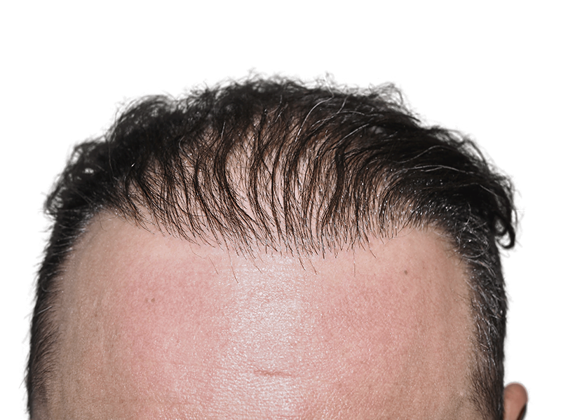 Thinning hairline & forehead scar. Possible hair transplant before. Hair restoration options available.