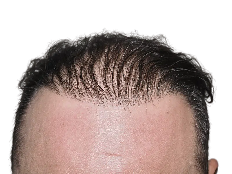Thinning hairline & forehead scar. Possible hair transplant before. Hair restoration options available.