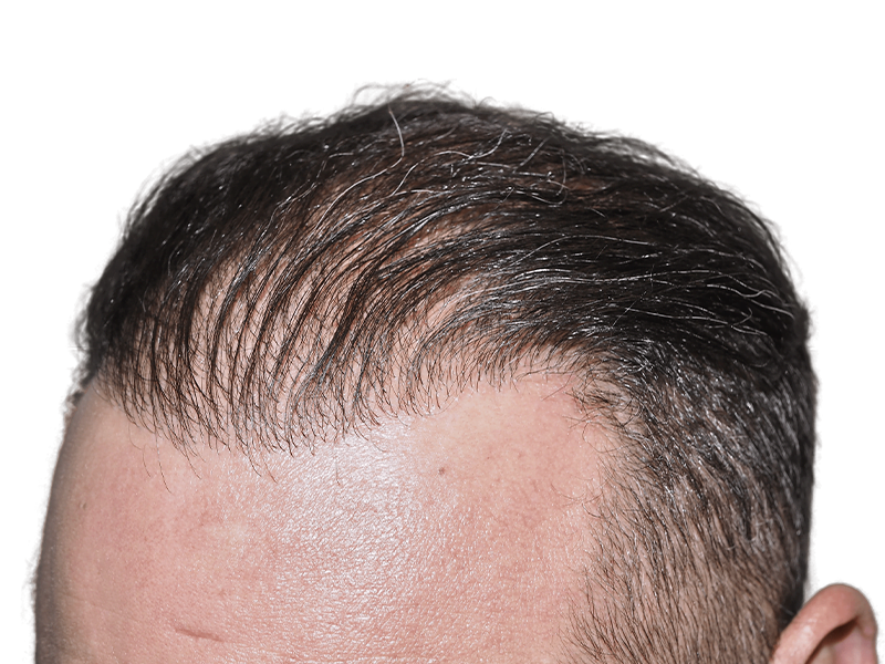 Receding hairline close-up. Potential hair transplant result. Thinning dark hair with gray. Hair restoration option.