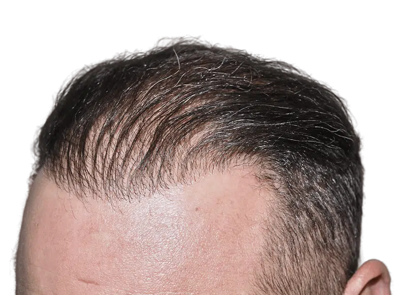 Receding hairline close-up. Potential hair transplant result. Thinning dark hair with gray. Hair restoration option.