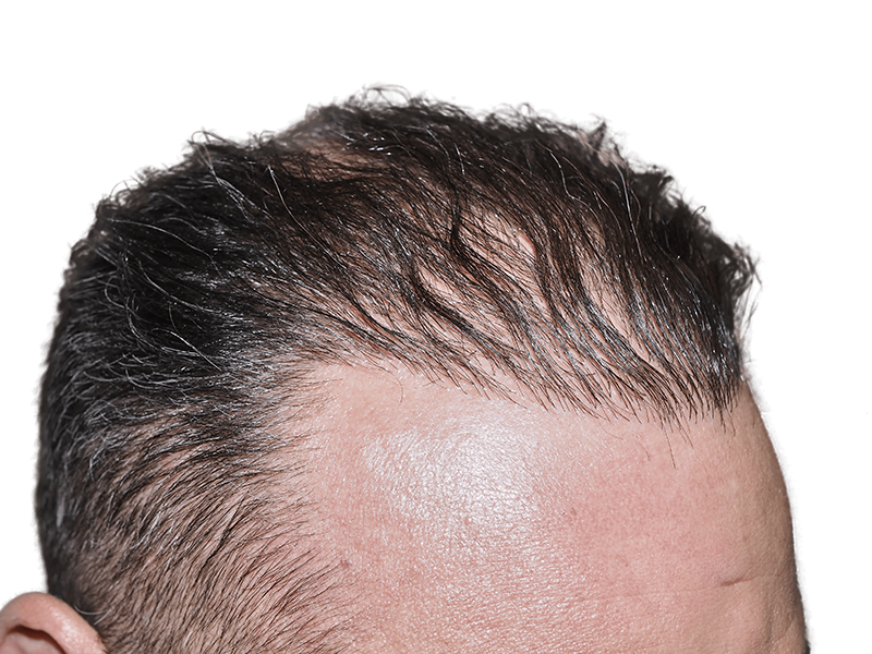 Hair transplant result: Man's forehead showing restored hairline. Before & after hair restoration example.