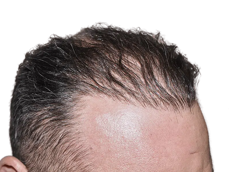 Hair transplant result: Man's forehead showing restored hairline. Before & after hair restoration example.