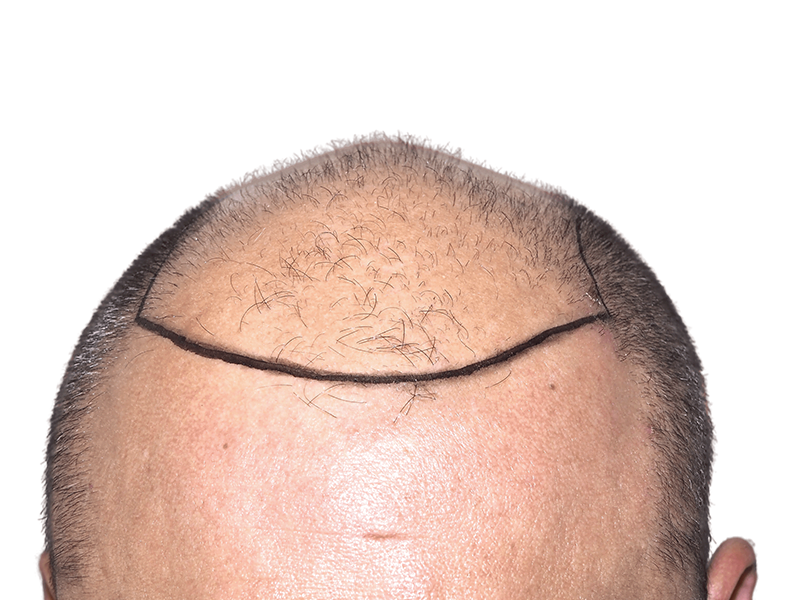 Before hair transplant: Balding man with marked hairline. Hair restoration procedure planning.