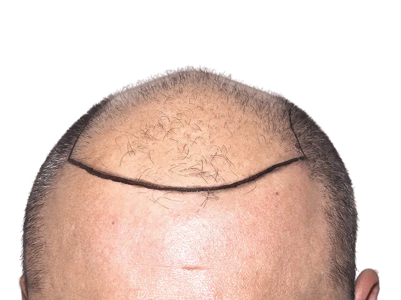 Before hair transplant: Balding man with marked hairline. Hair restoration procedure planning.