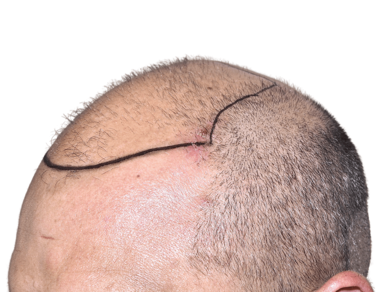 Hair transplant result: New hairline marked. Sparse hair above, denser transplanted hair below. Hair restoration progress.