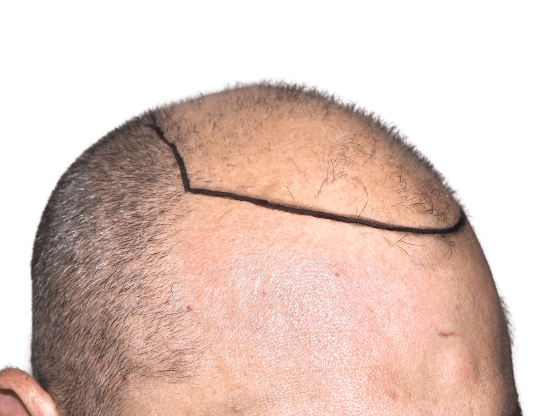 Hair transplant: Before. Balding Caucasian man with marked hairline. Hair restoration procedure planned for improved density.