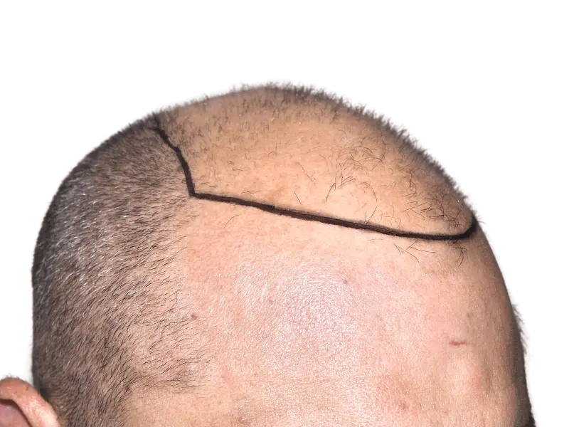 Hair transplant: Before. Balding Caucasian man with marked hairline. Hair restoration procedure planned for improved density.