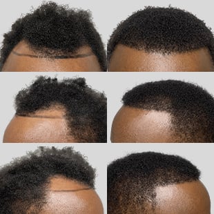 Hair transplant results: African American men's before & after photos show restored hairlines and increased hair density.