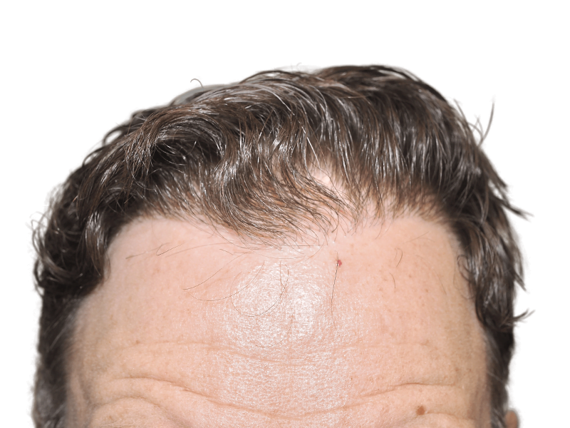 Before hair transplant: Thinning, graying hairline on Caucasian male. Hair restoration candidate. Forehead close-up.