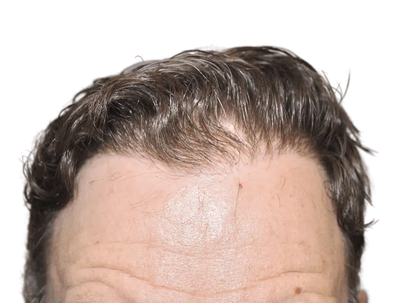 Before hair transplant: Thinning, graying hairline on Caucasian male. Hair restoration candidate. Forehead close-up.