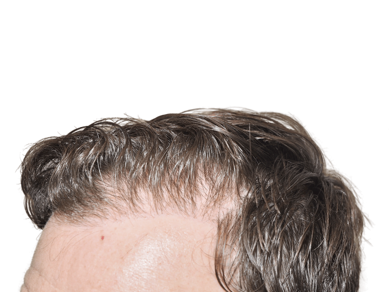 Receding hairline before hair transplant. Short, thinning hair. Hair restoration candidate. Before procedure.