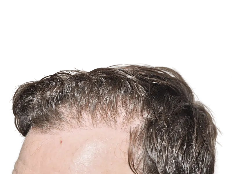 Receding hairline before hair transplant. Short, thinning hair. Hair restoration candidate. Before procedure.