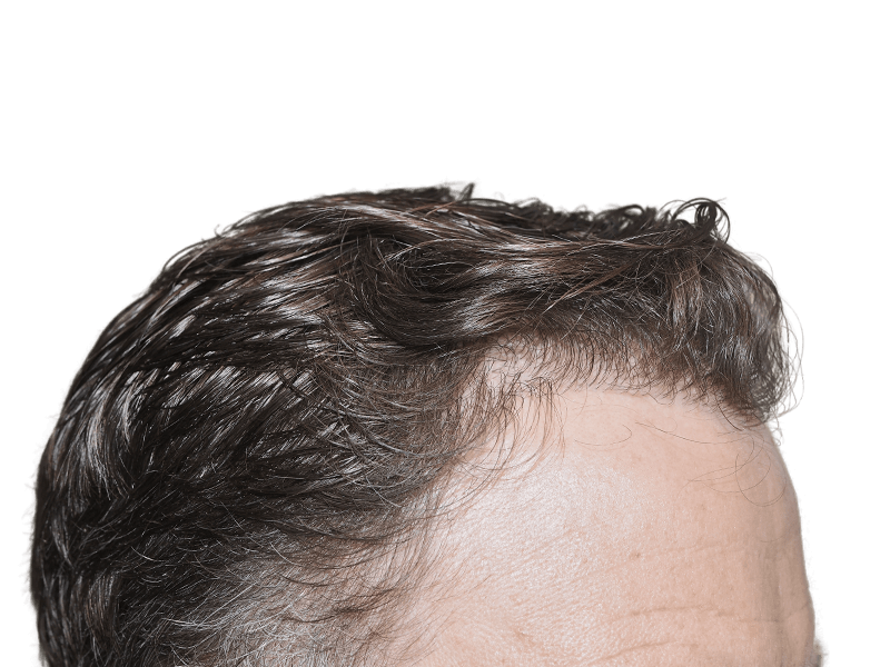 Hair restoration result? Top view of styled hair, showing possible hair transplant density. Before/after comparison needed.