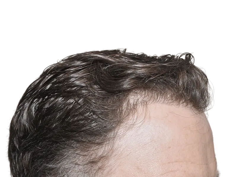 Hair restoration result? Top view of styled hair, showing possible hair transplant density. Before/after comparison needed.