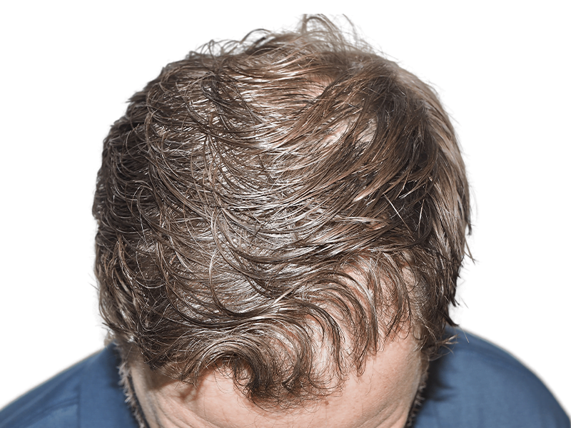 Man with thinning light brown hair. Potential hair transplant before/after. Styled to conceal hair loss. Hair restoration possible.