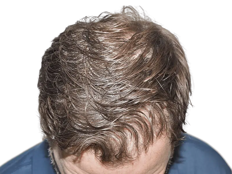 Man with thinning light brown hair. Potential hair transplant before/after. Styled to conceal hair loss. Hair restoration possible.