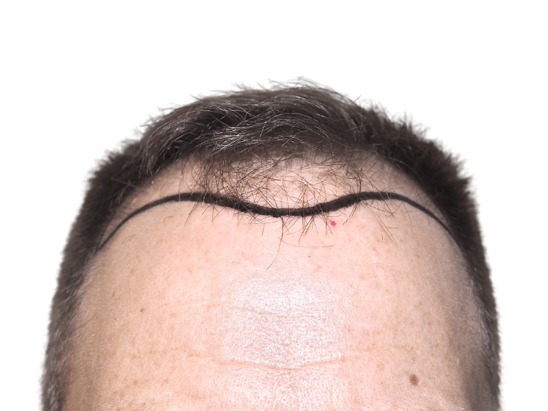 Before hair transplant: Marked receding hairline. Planning for hair restoration procedure. Shows potential hairline result.