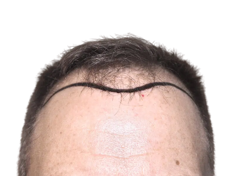 Before hair transplant: Marked receding hairline. Planning for hair restoration procedure. Shows potential hairline result.