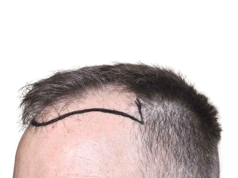 Hair transplant planning: Marked hairline on man showing thinning hair. Hair restoration procedure preview.
