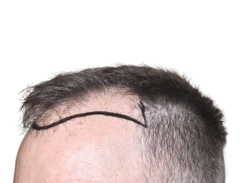 Hair transplant planning: Marked hairline on man showing thinning hair. Hair restoration procedure preview.