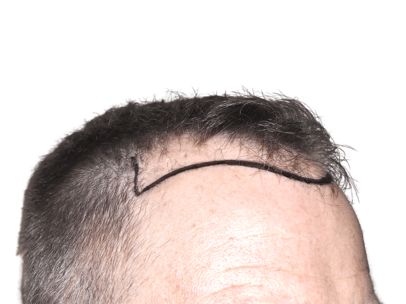 Hair transplant marking on hairline. Preparing for hair restoration procedure. Before treatment for thinning hair.
