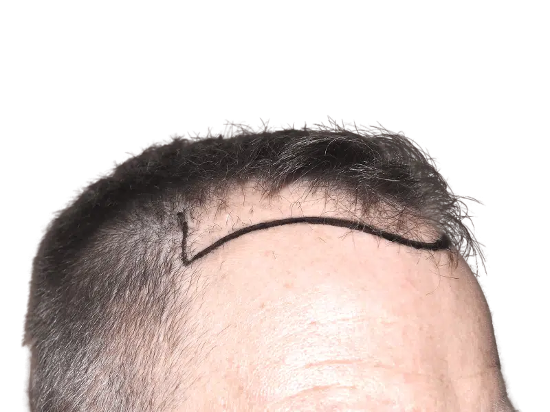 Hair transplant marking on hairline. Preparing for hair restoration procedure. Before treatment for thinning hair.