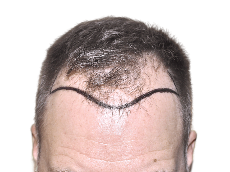 Before hair transplant: Marked hairline on man with receding hair. Hair restoration procedure planning.