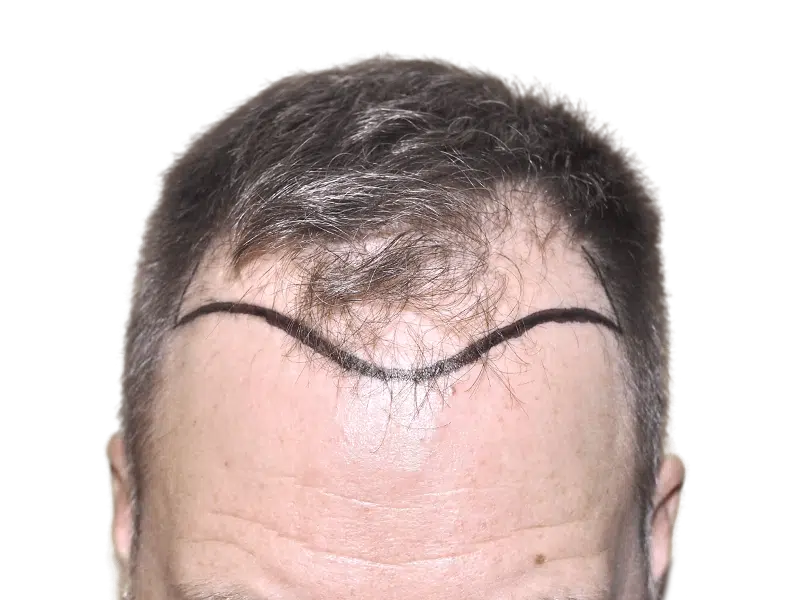 Before hair transplant: Marked hairline on man with receding hair. Hair restoration procedure planning.